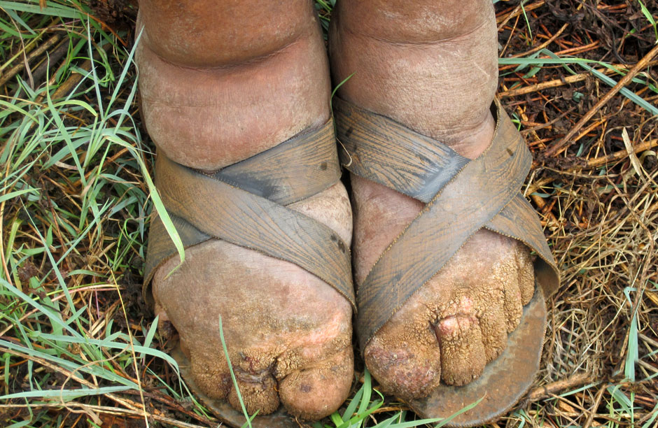 The feet of an Ethiopian farmer effected by a disease called "Podoconiosis", which is caused by a build-up of silica in the vascular and lymphatic system. The disease is caused by walking barefoot on soil with high silica content. It is completely preventable by wearing shoes.